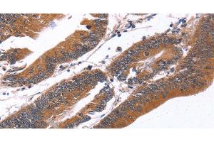 Immunohistochemistry of paraffin-embedded Human colon cancer tissue using GREB1 Polyclonal Antibody at dilution 1:40