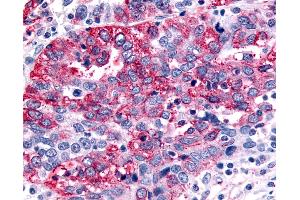 Anti-GABABR1 / GABBR1 antibody IHC of human Ovary, Carcinoma.