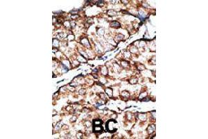 Formalin-fixed and paraffin-embedded human cancer tissue reacted with DKKL1 polyclonal antibody  , which was peroxidase-conjugated to the secondary antibody, followed by DAB staining.