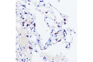 Immunohistochemistry of paraffin-embedded human lung using SFTPC antibody (ABIN3015597, ABIN3015598, ABIN3015599, ABIN1682683 and ABIN6218961) at dilution of 1:200 (40x lens).