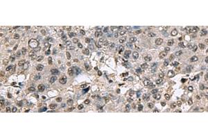 Immunohistochemistry of paraffin-embedded Human liver cancer tissue using TMX3 Polyclonal Antibody at dilution of 1:70(x200) (TMX3 anticorps)