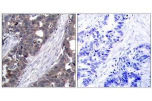 Immunohistochemical analysis of paraffin-embedded human breast carcinoma tissue using p70 S6 Kinase (Ab-411) antibody (E021261). (RPS6KB1 anticorps)