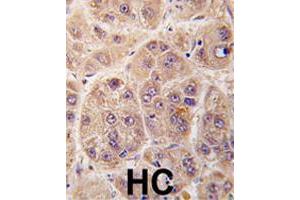 Formalin-fixed and paraffin-embedded human hepatocellular carcinoma reacted with PIM3 polyclonal antibody  , which was peroxidase-conjugated to the secondary antibody, followed by DAB staining. (PIM3 anticorps  (C-Term))