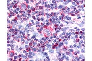 Anti-Nor-1 / NR4A3 antibody IHC of human Lymph Node, Hodgkins Lymphoma.