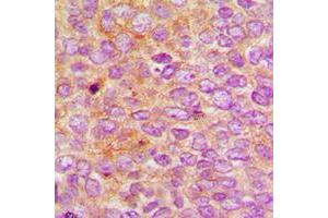 Immunohistochemical analysis of Nephrocystin 5 staining in human breast cancer formalin fixed paraffin embedded tissue section. (IQCB1 anticorps  (Center))