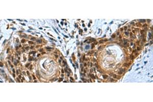 Immunohistochemistry of paraffin-embedded Human esophagus cancer tissue using ITGB1BP1 Polyclonal Antibody at dilution of 1:50(x200) (ITGB1BP1 anticorps)