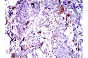 Immunohistochemical analysis of paraffin-embedded breast cancer tissues using GPNMB mouse mAb with DAB staining.