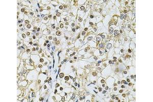 Immunohistochemistry of paraffin-embedded Human kidney cancer using IFI16 Polyclonal Antibody at dilution of 1:100 (40x lens).