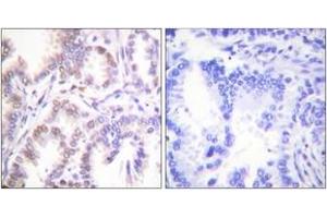 Immunohistochemistry analysis of paraffin-embedded human lung carcinoma tissue, using CDK7 Antibody.
