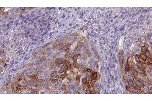 ABIN6275668 at 1/100 staining Human urothelial cancer tissue by IHC-P. (ATP6V1B1 anticorps  (Internal Region))