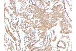 Formalin-fixed, paraffin-embedded human Leiomyosarcoma stained with Smooth Muscle Actin Monoclonal Antibody (1A4 + ACTA2/791).