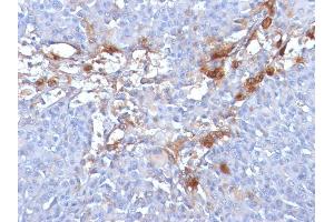 Formalin-fixed, paraffin-embedded human Melanoma stained with MUC18 Mouse Monoclonal Antibody (MUC18/1130). (MCAM anticorps)