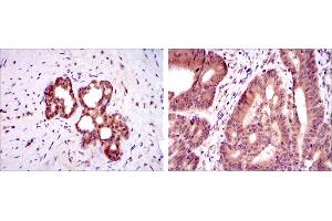 Immunohistochemical analysis of paraffin-embedded prostate tissues (left) and colon cancer tissues (right) using OTX2 mouse mAb with DAB staining. (OTX2 anticorps)