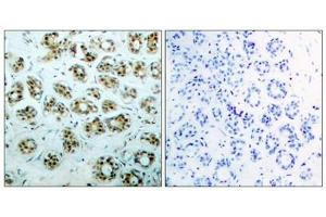 Immunohistochemical analysis of paraffin-embedded human breast carcinoma tissue, using NFκ,B-p65 (phospho-Ser311) antibody.