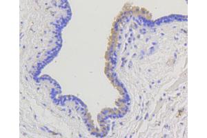 Immunohistochemistry of paraffin-embedded human mammary cancer using ARRB1 antibody (ABIN4903044) at dilution of 1:100 (40x lens). (beta Arrestin 1 anticorps)