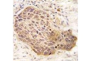 IHC analysis of FFPE human lung carcinoma tissue stained with RIPK2 antibody