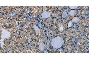 Immunohistochemistry of paraffin-embedded Human thyroid cancer using GYS1 Polyclonal Antibody at dilution of 1:50 (Glycogen Synthase 1 anticorps)