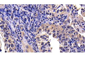 Detection of CASP10 in Human Endometrial cancer Tissue using Polyclonal Antibody to Caspase 10 (CASP10)