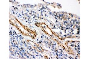 IHC-P: IKKb antibody testing of human lung cancer tissue (IKBKB anticorps  (AA 398-756))