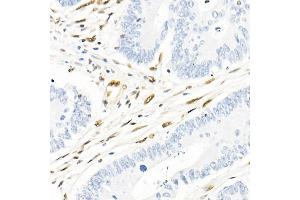 Immunohistochemistry of paraffin-embedded human colon carcinoma using QKI Rabbit mAb (ABIN7269699) at dilution of 1:1000 (40x lens).
