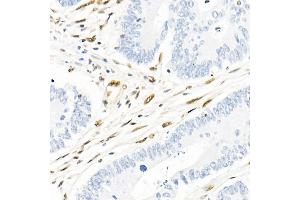 Immunohistochemistry of paraffin-embedded human colon carcinoma using QKI Rabbit mAb (ABIN7269699) at dilution of 1:1000 (40x lens). (QKI anticorps)