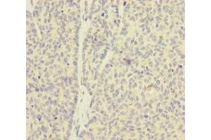 Immunohistochemistry of paraffin-embedded human ovarian cancer using ABIN7154941 at dilution of 1:100 (SKIV2L anticorps  (AA 1-140))