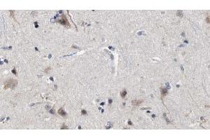 ABIN6272850 at 1/100 staining Human brain cancer tissue by IHC-P.
