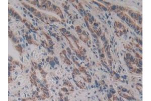 Detection of VNN1 in Human Stomach cancer Tissue using Polyclonal Antibody to Vanin 1 (VNN1) (VNN1 anticorps  (AA 36-223))