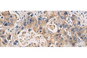 Immunohistochemistry of paraffin-embedded Human liver cancer tissue using DMRTA2 Polyclonal Antibody at dilution of 1:50(x200) (DMRTA2 anticorps)