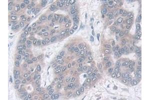 Detection of IDH2 in Human Liver cancer Tissue using Polyclonal Antibody to Isocitrate Dehydrogenase 2, mitochondrial (IDH2)