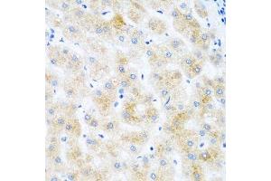 Immunohistochemistry of paraffin-embedded human liver cancer using DHODH antibody.