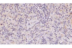 ABIN6273086 at 1/100 staining Human lymph cancer tissue by IHC-P.