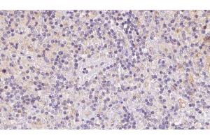 ABIN6273086 at 1/100 staining Human lymph cancer tissue by IHC-P. (VPS16 anticorps  (Internal Region))