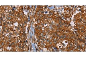 Immunohistochemistry of paraffin-embedded Human breast cancer tissue using PLEC Polyclonal Antibody at dilution 1:40 (PLEC anticorps)