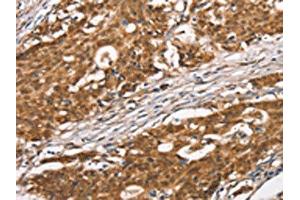 The image on the left is immunohistochemistry of paraffin-embedded Human gastric cancer tissue using ABIN7190465(DGAT1 Antibody) at dilution 1/40, on the right is treated with synthetic peptide. (DGAT1 anticorps)
