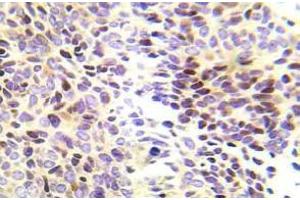 Immunohistochemistry (IHC) analyzes of CHK1 pAb in paraffin-embedded human lung adenocarcinoma tissue. (CHEK1 anticorps)