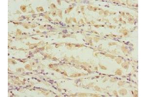 Immunohistochemistry of paraffin-embedded human gastric cancer using ABIN7146516 at dilution of 1:100 (Calpain S1 anticorps  (AA 69-268))
