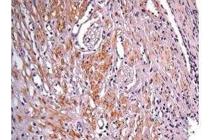 IHC-P Image Immunohistochemical analysis of paraffin-embedded human colon carcinoma, using IDH1, antibody at 1:100 dilution. (IDH1 anticorps  (Center))