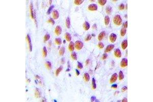 Immunohistochemical analysis of FOG2 staining in human breast cancer formalin fixed paraffin embedded tissue section. (ZFPM2 anticorps)