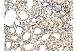 The image on the left is immunohistochemistry of paraffin-embedded Human thyroid cancer tissue using ABIN7192947(TSPYL6 Antibody) at dilution 1/20, on the right is treated with synthetic peptide. (TSPY-Like 6 anticorps)