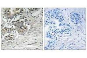 Immunohistochemistry analysis of paraffin-embedded human prostate carcinoma tissue using Claudin 7 (Ab-210) antibody. (Claudin 7 anticorps  (Tyr210))