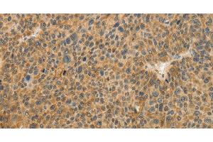 Immunohistochemistry of paraffin-embedded Human liver cancer tissue using TFPI2 Polyclonal Antibody at dilution 1:30 (TFPI2 anticorps)
