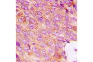 Immunohistochemical analysis of DOK2 (pY299) staining in human breast cancer formalin fixed paraffin embedded tissue section.