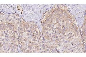 ABIN6273328 at 1/100 staining Human thyroid cancer tissue by IHC-P. (TBC1D23 anticorps  (Internal Region))