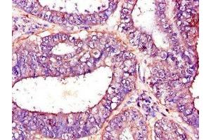 Immunohistochemistry of paraffin-embedded human endometrial cancer using ABIN7144954 at dilution of 1:100