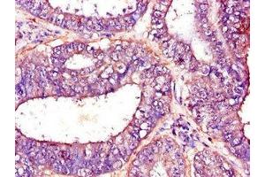 Immunohistochemistry of paraffin-embedded human endometrial cancer using ABIN7144954 at dilution of 1:100 (PFKM anticorps  (AA 166-334))