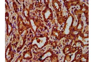 IHC image of ABIN7151907 diluted at 1:300 and staining in paraffin-embedded human liver cancer performed on a Leica BondTM system. (EGFL7 anticorps  (AA 73-198))