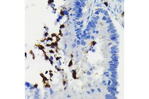 Immunohistochemistry of paraffin-embedded human colon carcinoma using FADD Rabbit mAb (ABIN7267135) at dilution of 1:100 (40x lens).