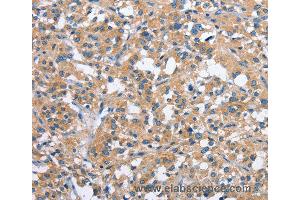 Immunohistochemistry of Human thyroid cancer using PAK2 Polyclonal Antibody at dilution of 1:40 (PAK2 anticorps)