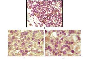 Immunohistochemical analysis of paraffin-embedded human lymphoid (A), ovary tumor (B) and testicle tumor (C) tissues using INHA antibody with DAB staining. (Inhibin alpha anticorps)